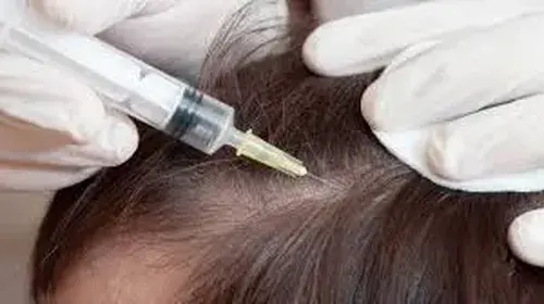 Intralesional steroid injection for hair loss